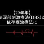 【2040年】脳深部刺激療法(DBS)が依存症治療法に